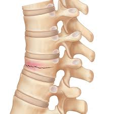 Image result for Vertebral Compression Fracture