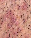 How To Get Rid Of Razor Bump Scars On Vag
