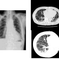 It is known that chrysotile asbestos causes asbestosis, and this is one of the six different types of asbestos. The Chest X Ray 3a Indicates Bilateral Irregular Opacity And Download Scientific Diagram