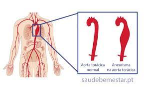 Um aneurisma da aorta abdominal é uma área aumentada na parte inferior do vaso principal que fornece sangue ao corpo (aorta). Aneurisma Da Aorta Toracica Causas Sintomas Tratamento Cirurgia
