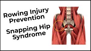 Image result for Snapping Hip