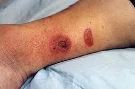 Necrotizing fasciitis is a rare infection that spreads along the superficial fascia, compromising the subcutaneous tissue between the skin and underlying muscle. Cellulitis Practice Essentials Background Pathophysiology