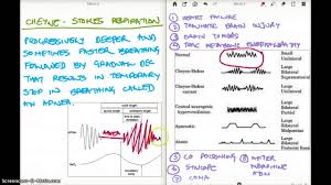 Image result for Cheyne-Stokes Respiration