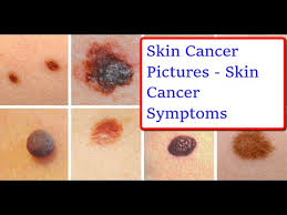 The stage of a cancer describes the size of a tumour and how far it has spread from where it originated. Whizolosophy Skin Cancer Pictures Pictures Of Skin Cancer Symptoms
