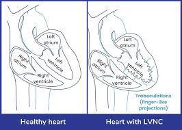 Image result for Left Ventricular Noncompaction