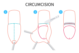 Image result for paraphimosis