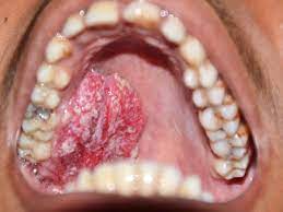 Bleeding or pain on the lips. Can Ai Help Better Predict Mouth Cancer Risk Uk Scientists Think So Times Of India