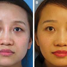 Case 2: (A) A female patient with thick eyelid soft tissue in both...