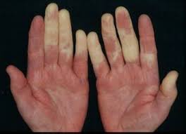 Mixed Connective Tissue Disease Mctd Bone Joint And Muscle Disorders Msd Manual Consumer Version