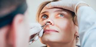 Cat depre operatia de deviatie de sept, nu exista operatie cu laser, daca cineva va spune altfel inseamna ca va minte si o. Deviatia De Sept Cauze Simptome Tratament Operatie