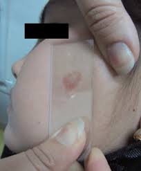 Image result for Diascopy