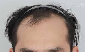 Some types of hair loss are permanent, like male and female pattern baldness. Home Maxwell Hair Clinic