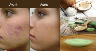 Appliquez Ce Masque 2 Fois Par Semaine Vos Cicatrices Boutons D Acne Et Taches Vont Disparaitre Comme Par Magie Bouton Acne Cicatrice Bouton Cicatrices Acne