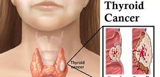 Patients under 45 years of age and those aged 45 or over can have different prognosis for tumours of similar characteristics. Thyroid Cancer Pertubuhan Pencegahan Kanser Pulau Pinang