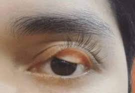 This causes irritation and discomfort. Eyelid Twisting Wordreference Forums