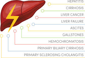 fatty liver diet guide