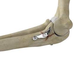 Image result for Coronoid Process Fracture