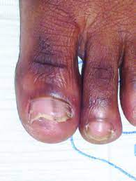 These look like bruises under the nails, and are usually along the bottom edge of the nail, near the cuticle. How To Detect Nail Unit Tumors Podiatry Today