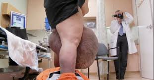 Avoir un testicule légèrement plus grand que l'autre est tout à fait normal. Video Reportage Sur L Operation De L Homme Aux Plus Gros Testicules Du Monde