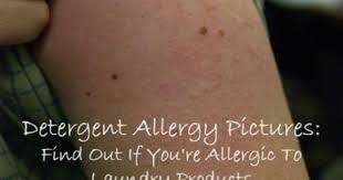 Detergent Allergy Pictures Find Out If You Re Allergic To Laundry Detergent Laundry Detergent Allergy Allergic Reaction Rash Method Laundry Detergent