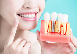 Dental Implants Longmont CO - Natural Looking Teeth Replacements