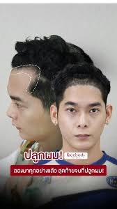 FACEBODY HAIR (หมอธีร์) แพทย์ผู้เชี่ยวชาญด้านการปลูกถ่ายเส้นผม