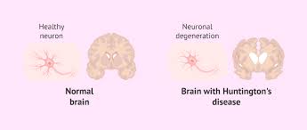 Image result for Chorea