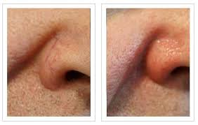 Telangiectasias are small, widened blood vessels on the skin. Treatment For Telangiectasia Or Red Spider Veins A New You