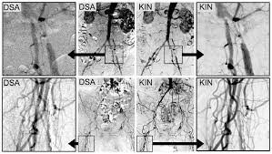 Ez azért is fontos, hogy csökkenjen a betegek száma. Digital Variance Angiography Wikipedia