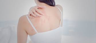 Image result for sweat rash on back