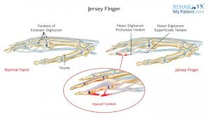 With this flexor tendon no longer attached, the fingertip can't bend down anymore, though the. Jersey Finger Rehab My Patient