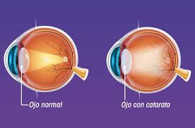 Las cataratas en los ojos son una afección común en la tercera edad, por eso es importante conocer sus factores de riesgo, síntomas y tratamiento. Cataratas Centro Medico De La Vision Tienes Mala Vision