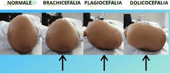 Image result for Positional Head Deformity