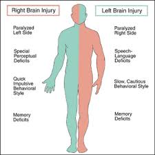 Left Vs Right Brain Stroke Stroke Of Misfortune Living