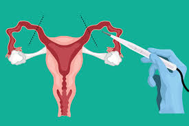 Image result for Vasectomy