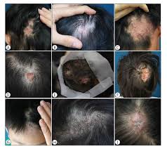 Image result for Tinea Capitis