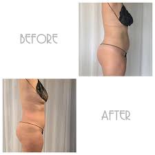 4 steps and $300 later, this kitchen looks brand new there are about a million projects you can do to upgrade a kitchen: Sculptery A Perfected Approach To Wood Therapy Ice Therapy For Body Contouring And Body Sculpting Activating The Lymphatic System To Drain Toxins Promote Drainage Of Excess Water Weight And Fluids An