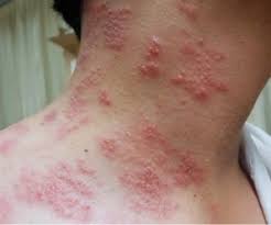 Image result for shingles