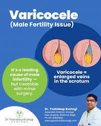 Image result for Varicocele