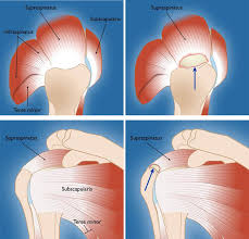 Image result for Rotator Cuff Rupture