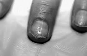 Image result for Muehrcke Line