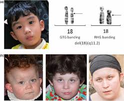 18q Deletion Syndrome Causes Symptoms Diagnosis Treatment Life Expectancy
