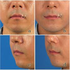Corner Mouth Lift- Lateral Oral Commissure In Santa Barbara