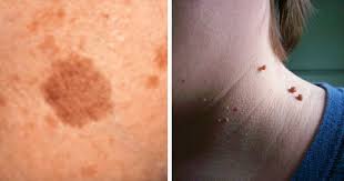 The first thing you should always do is to see your doctor to get it likewise, some people choose to remove their moles for cosmetic reasons especially if they appear in very visible places on the body such as the face or. Here S 25 Ways To Naturally Resolve Skin Tags Warts Blackheads Moles And Age Spots