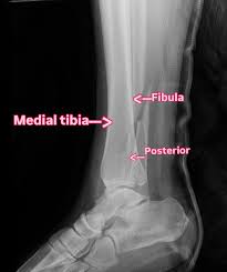 Image result for Ankle Dislocation