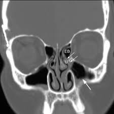 Image result for Maxillary Sinus