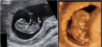 Check spelling or type a new query. Ecografia En La Semana 9 Aun Es Un Embrion Natalben