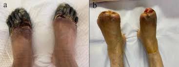Image result for diabetic toes