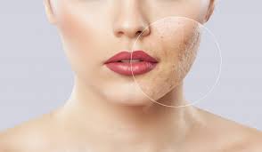 As the chemical bonds absorb uv radiation, the sunscreen components slowly break down and release heat. How To Get Rid Of Acne Scars According To The Experts