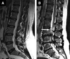 Learn about diagnosis, including mri testing. Scielo Brasil Cauda Equina Redundant Nerve Roots Are Associated To The Degree Of Spinal Stenosis And To Spondylolisthesis Cauda Equina Redundant Nerve Roots Are Associated To The Degree Of Spinal